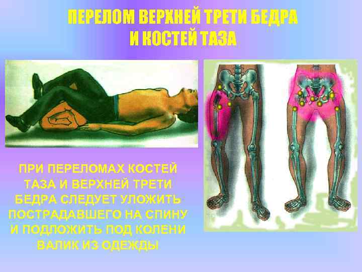 ПЕРЕЛОМ ВЕРХНЕЙ ТРЕТИ БЕДРА И КОСТЕЙ ТАЗА ПРИ ПЕРЕЛОМАХ КОСТЕЙ ТАЗА И ВЕРХНЕЙ ТРЕТИ