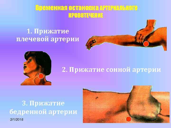 Временная остановка АРТЕРИАЛЬНОГО КРОВОТЕЧЕНИЕ 1. Прижатие плечевой артерии 2. Прижатие сонной артерии 3. Прижатие