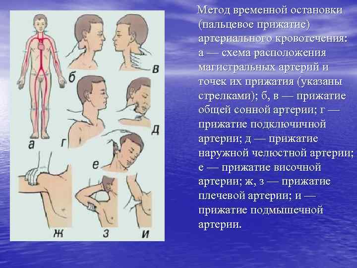 Пальцевое прижатие. Остановка кровотечения методом пальцевого прижатия. Метод пальцевого прижатия артерий. Способы остановки артериального кровотечения пальцевое прижатие. Метод временной остановки кровотечения пальцевое прижатие.