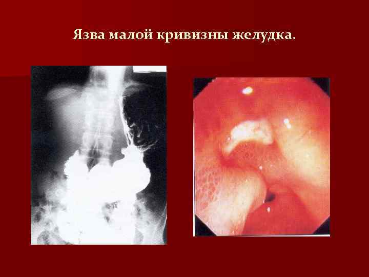 Язва малой кривизны желудка. 