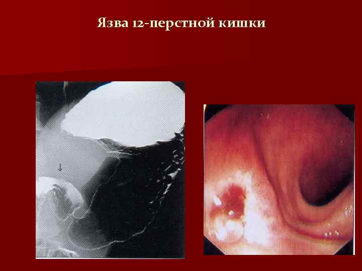 Язва 12 -перстной кишки 