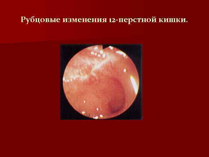 Рубцовые изменения 12 -перстной кишки. 