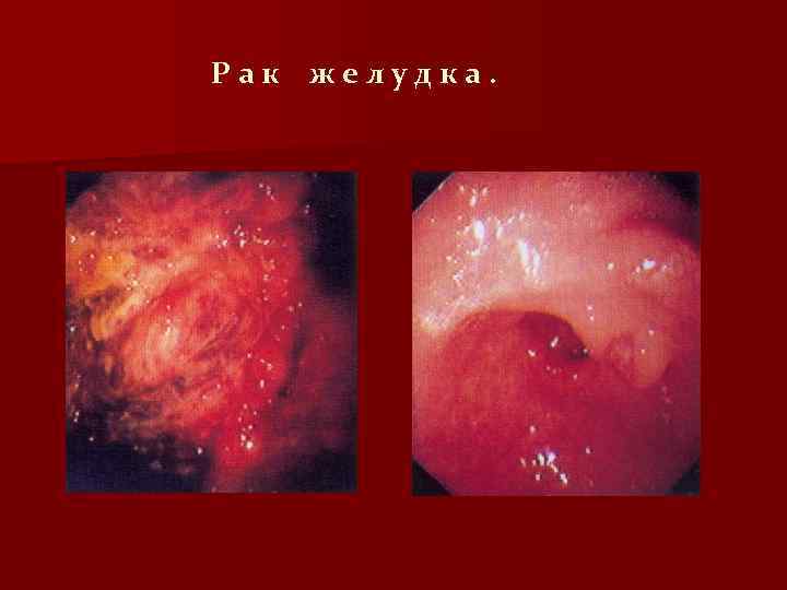 Рак желудка. 