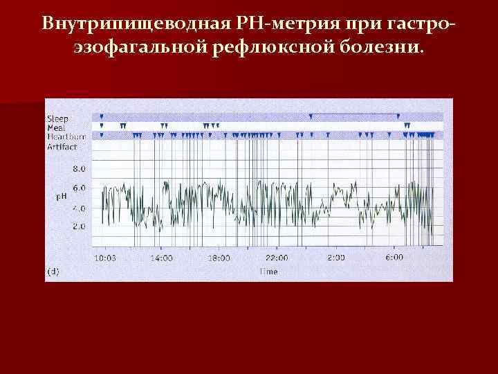 Внутрипищеводная РН-метрия при гастроэзофагальной рефлюксной болезни. 