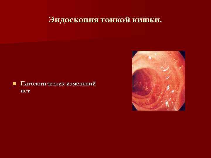 Эндоскопия тонкой кишки. n Патологических изменений нет 