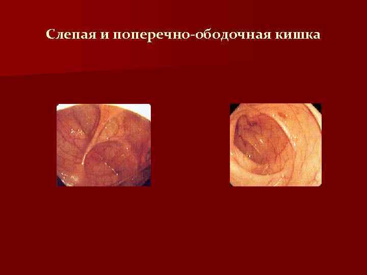 Слепая и поперечно-ободочная кишка 