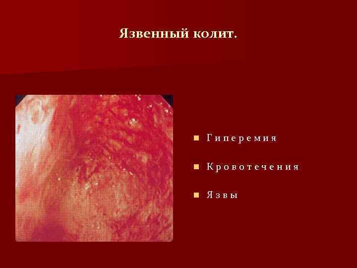 Язвенный колит. n Гиперемия n Кровотечения n Язвы 
