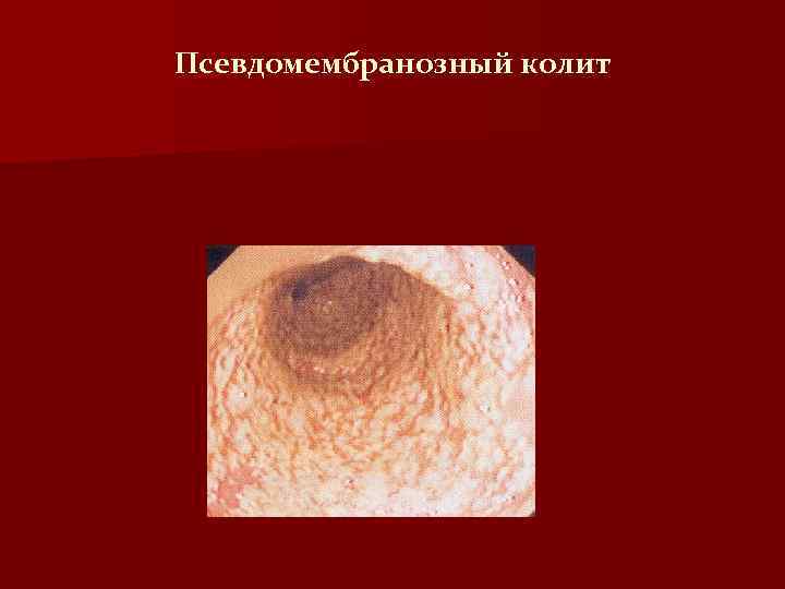 Псевдомембранозный колит 