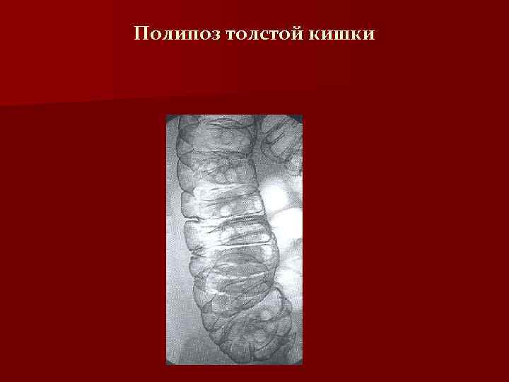 Полипоз толстой кишки 