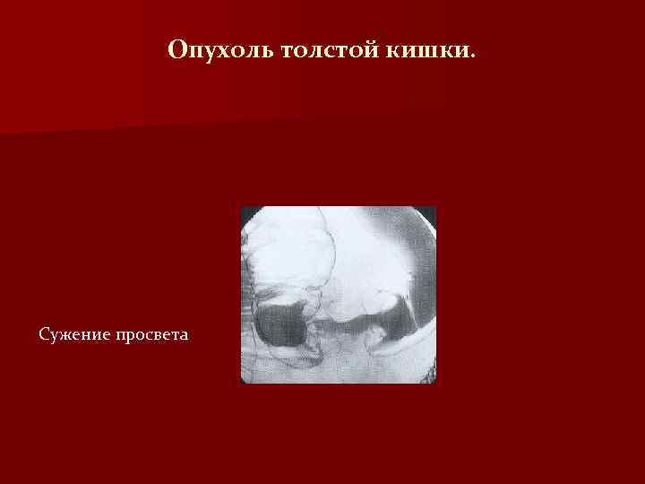 Опухоль толстой кишки. Сужение просвета 