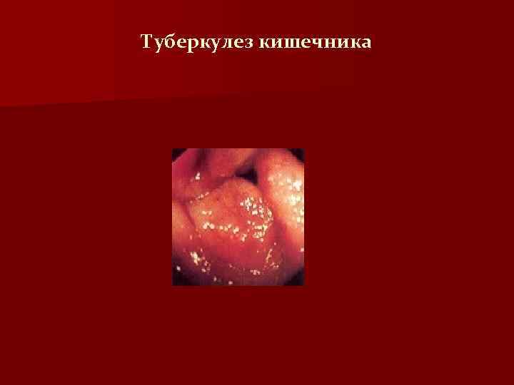 Туберкулез кишечника 