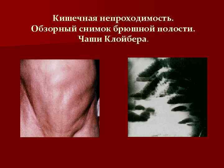 Кишечная непроходимость. Обзорный снимок брюшной полости. Чаши Клойбера. 