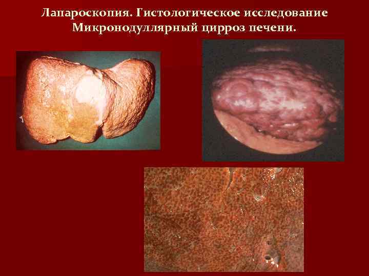 Лапароскопия. Гистологическое исследование Микронодуллярный цирроз печени. 