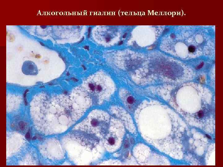 Алкогольный гиалин (тельца Меллори). 