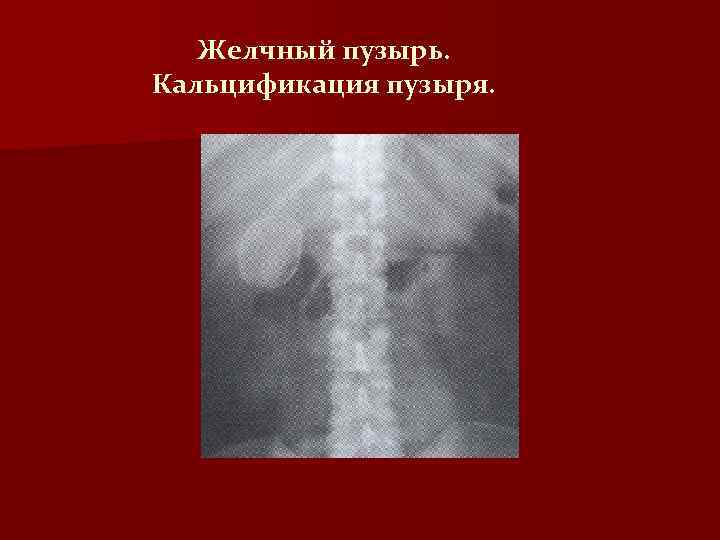 Желчный пузырь. Кальцификация пузыря. 
