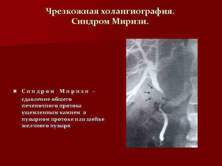 Чрезкожная холангиография. Синдром Миризи. n Синдром Миризи – сдавление общего печеночного протока ущемленным камнем