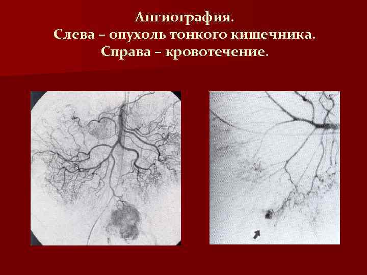 Ангиография. Слева – опухоль тонкого кишечника. Справа – кровотечение. 