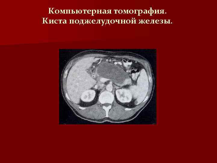 Компьютерная томография. Киста поджелудочной железы. 