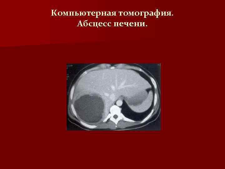Компьютерная томография. Абсцесс печени. 