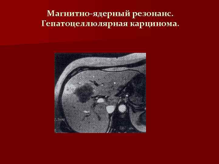 Магнитно-ядерный резонанс. Гепатоцеллюлярная карцинома. 