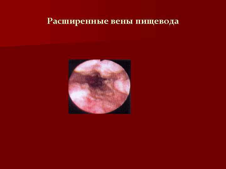 Расширенные вены пищевода 