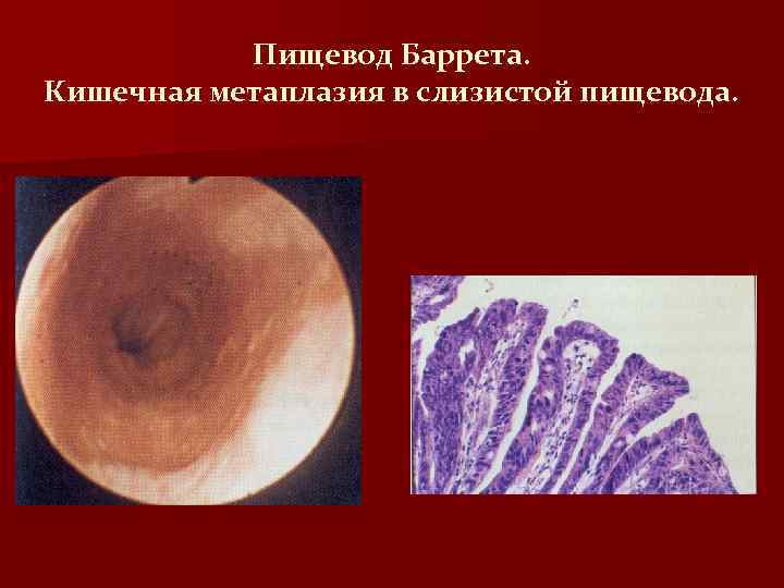 Пищевод Баррета. Кишечная метаплазия в слизистой пищевода. 