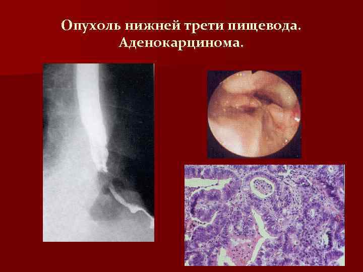 Опухоль нижней трети пищевода. Аденокарцинома. 