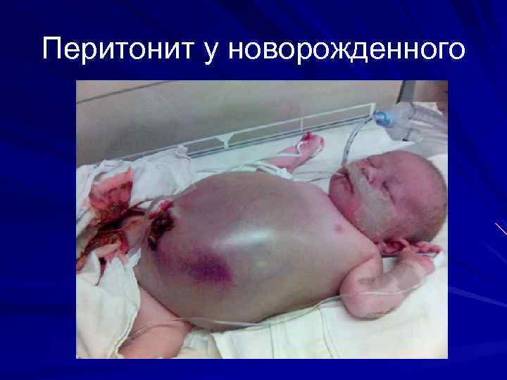Перитонит у новорожденного 