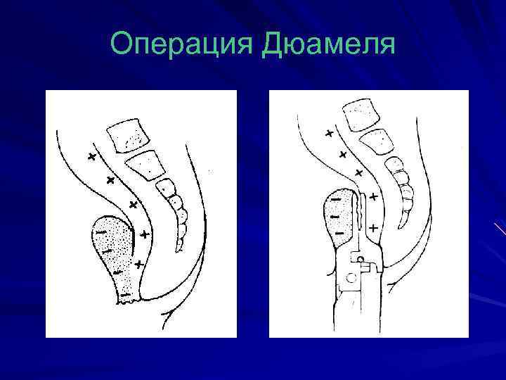 Операция Дюамеля 
