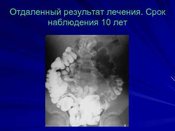 Отдаленный результат лечения. Срок наблюдения 10 лет 