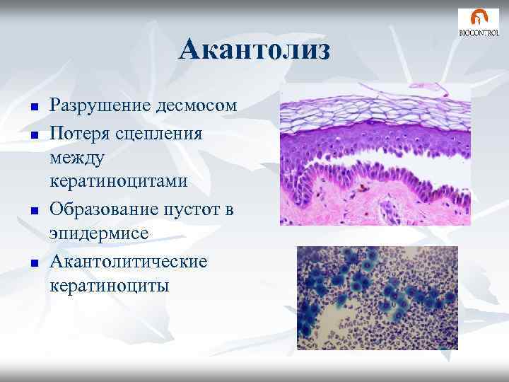 Акантолиз n n Разрушение десмосом Потеря сцепления между кератиноцитами Образование пустот в эпидермисе Акантолитические