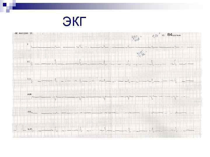 ЭКГ 