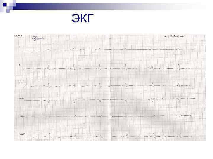 ЭКГ 