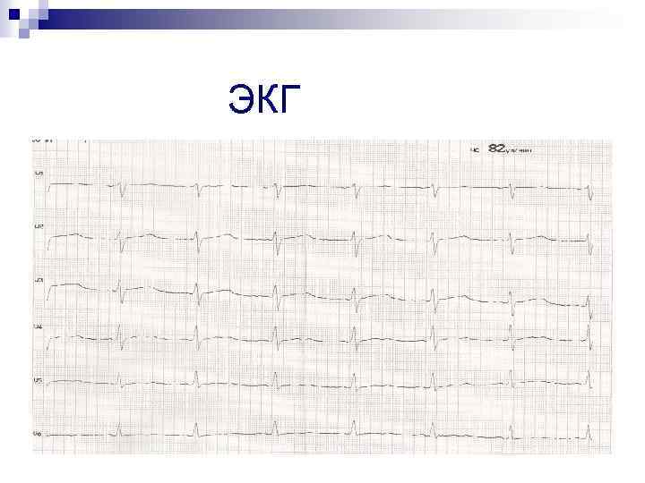 ЭКГ 