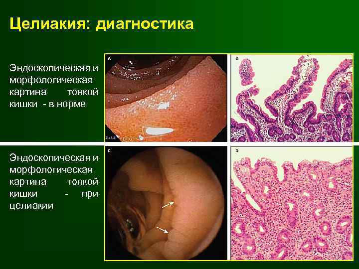 Онхоцеркоз человека схемы лечения