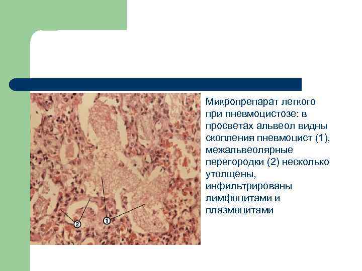 l Микропрепарат легкого при пневмоцистозе: в просветах альвеол видны скопления пневмоцист (1), межальвеолярные перегородки