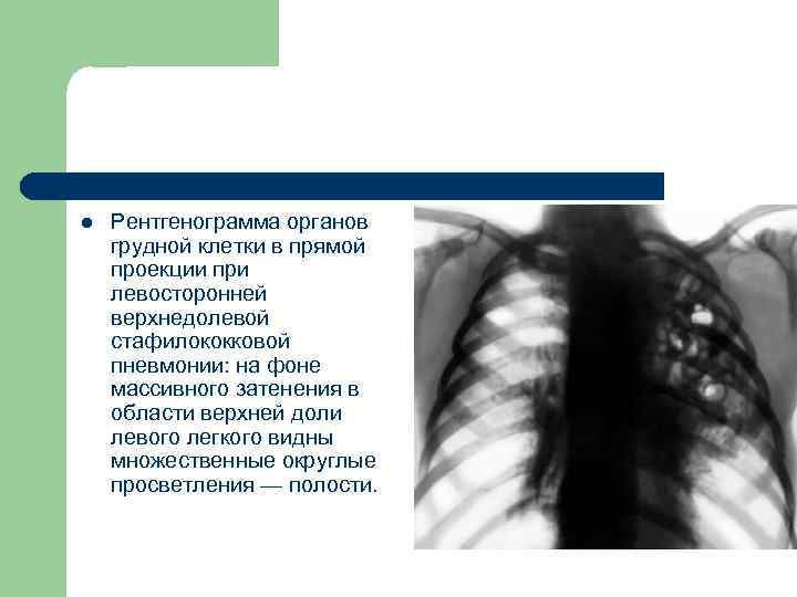 l Рентгенограмма органов грудной клетки в прямой проекции при левосторонней верхнедолевой стафилококковой пневмонии: на