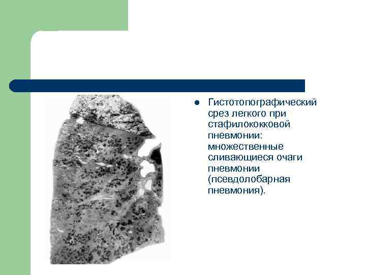 l Гистотопографический срез легкого при стафилококковой пневмонии: множественные сливающиеся очаги пневмонии (псевдолобарная пневмония). 