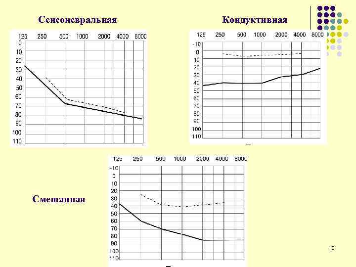 Сенсоневральная Кондуктивная Смешанная 10 