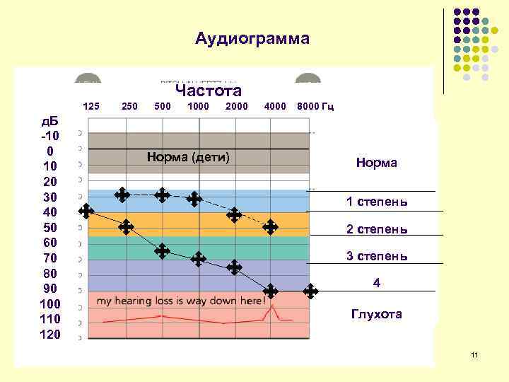 Аудиограмма Частота 125 д. Б -10 0 10 20 30 40 50 60 70