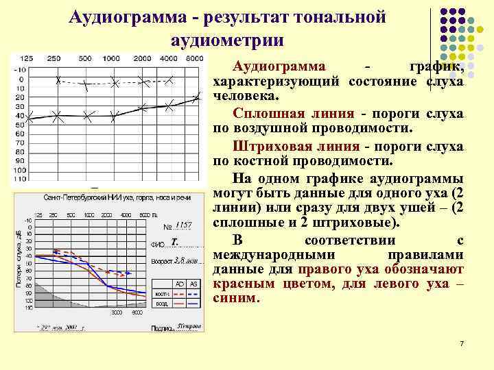 Аудиограмма - результат тональной аудиометрии Аудиограмма график, характеризующий состояние слуха человека. Сплошная линия -