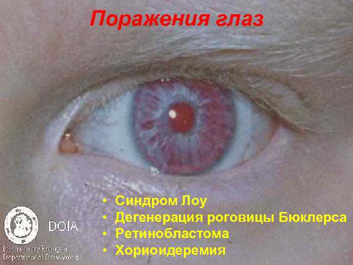 Поражения глаз • • Синдром Лоу Дегенерация роговицы Бюклерса Ретинобластома Хориоидеремия 
