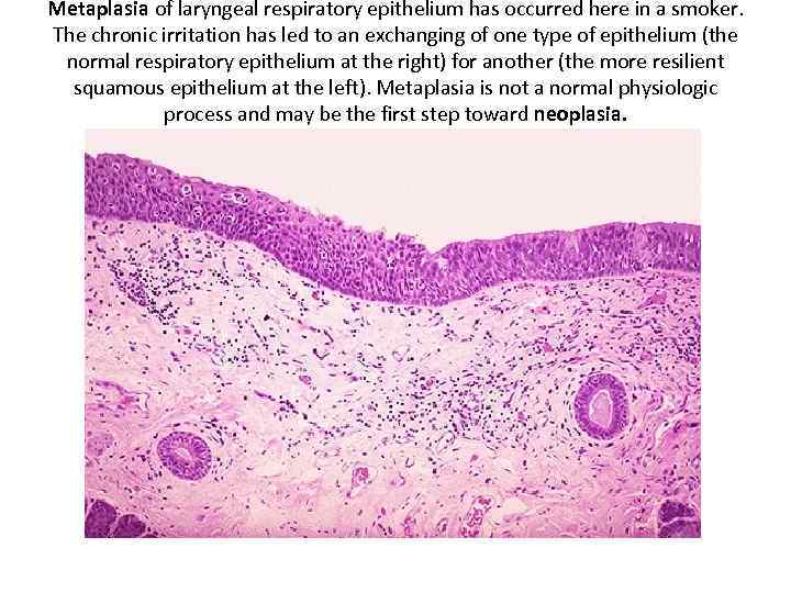 Metaplasia of laryngeal respiratory epithelium has occurred here in a smoker. The chronic irritation