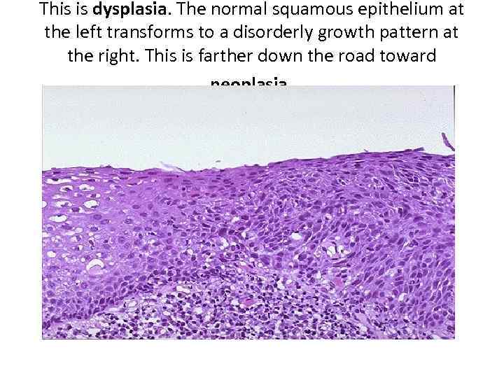 This is dysplasia. The normal squamous epithelium at the left transforms to a disorderly