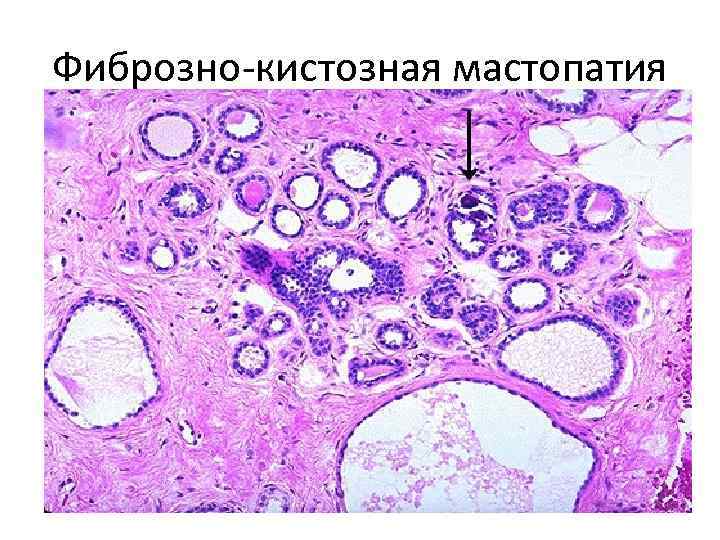 Фиброзно-кистозная мастопатия 