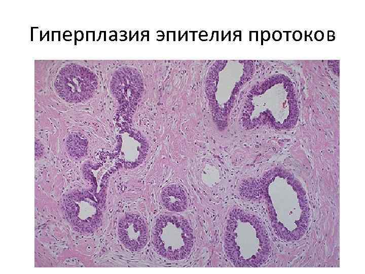 Гиперплазия эпителия протоков 