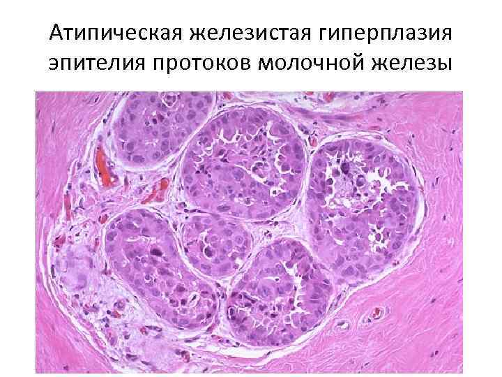 Атипическая железистая гиперплазия эпителия протоков молочной железы 