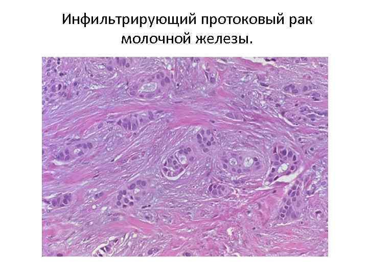 Инфильтрирующий протоковый рак молочной железы. 