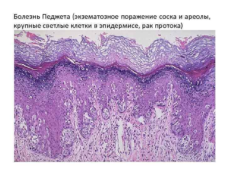 Болезнь Педжета (экзематозное поражение соска и ареолы, крупные светлые клетки в эпидермисе, рак протока)