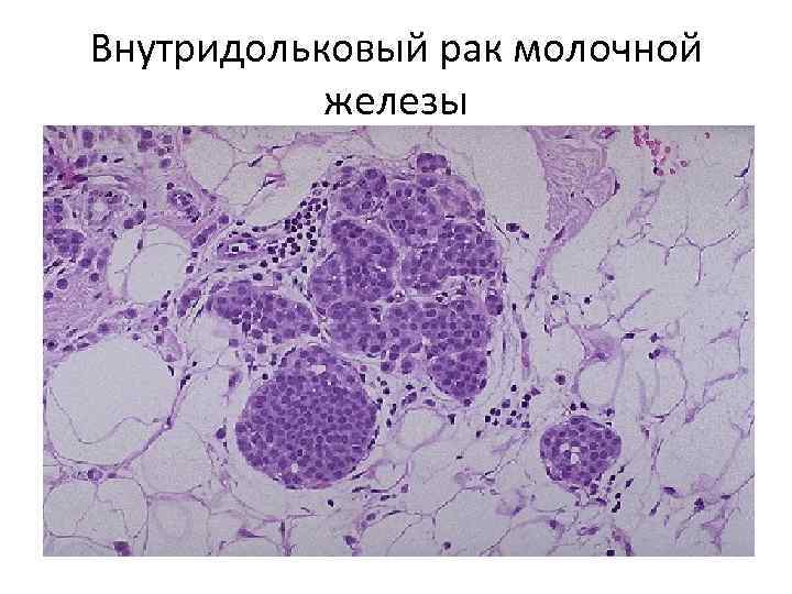 Внутридольковый рак молочной железы 